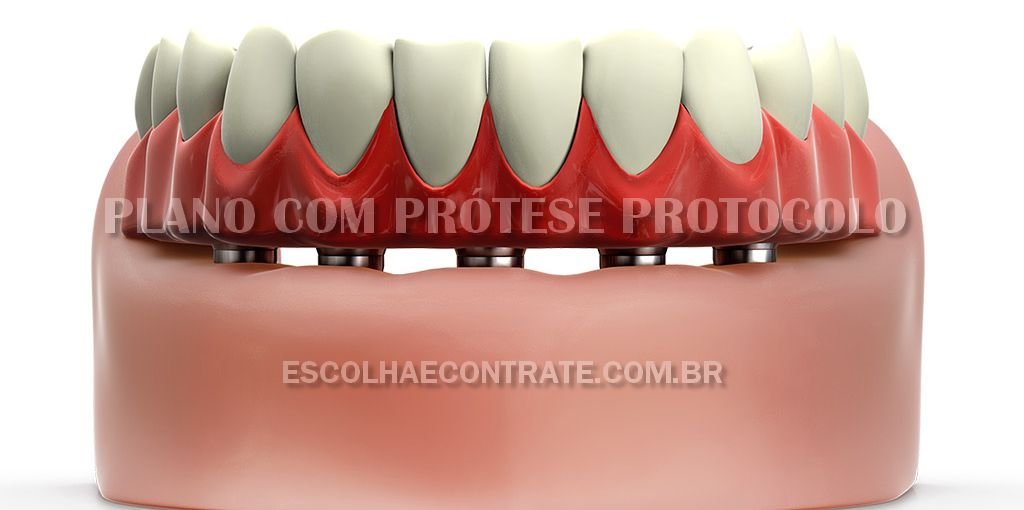Plano com Prótese Protocolo a partir de 349,90/mês