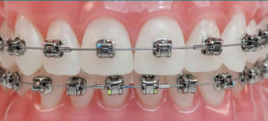 amil-dental-200-doc-aparelho-ortodontico