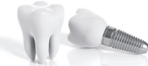 planos-dentários-com-implantes-banner