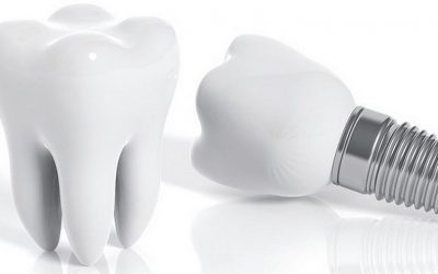 Plano com Implantes Dentários para Você Contratar 0 (0)