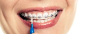 plano-dental-com-manutenção-de-aparelho
