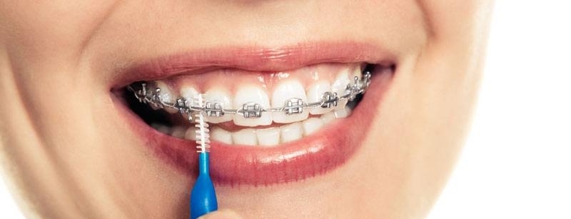 Plano Dental com Manutenção de Aparelho Sem Carência por 130,30/mês 4.3 (3)
